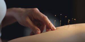 acupuntura